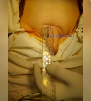 Surgical penile enlargement - before and after