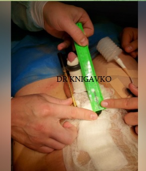 Photo "Before and After" ligamentotomy.