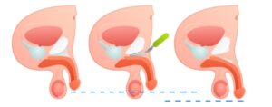 penis lengthening surgery in dubai