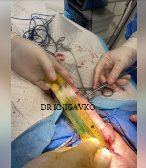 Surgical penile enlargement - before and after
