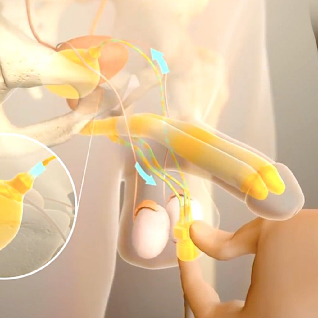 Penile Implant Surgery In Dubai