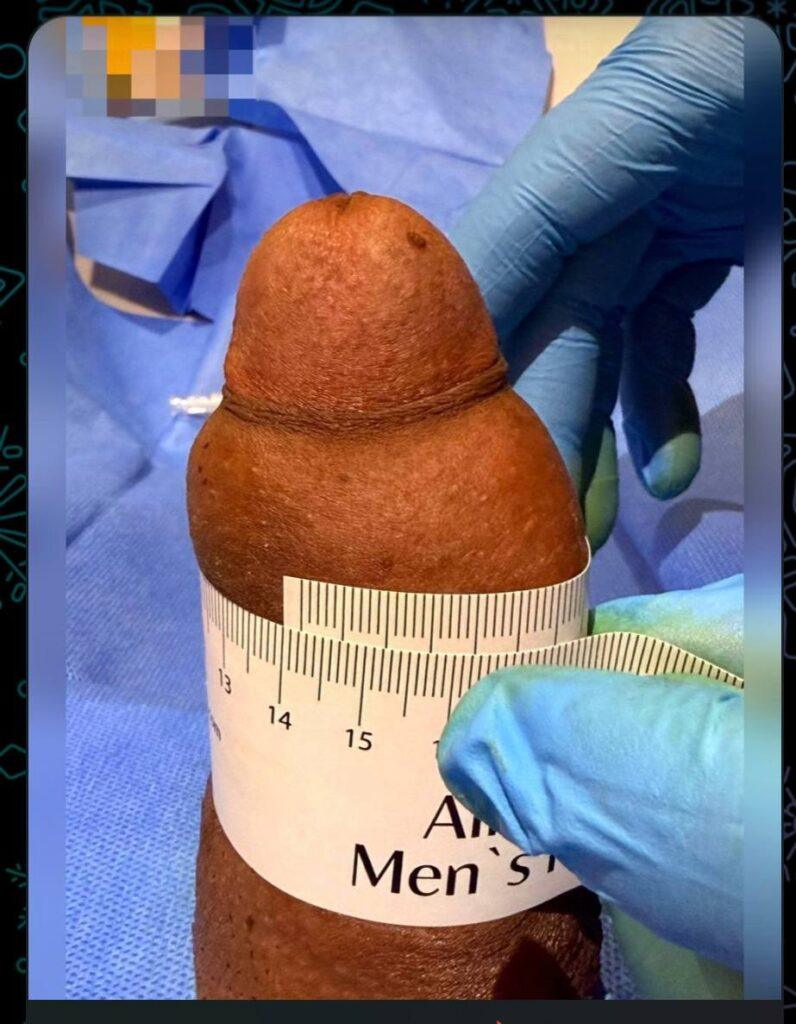 Before & After Photos of Non-Surgical Penile Girth Enhancement
